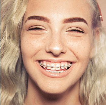 Fixed conventional braces
