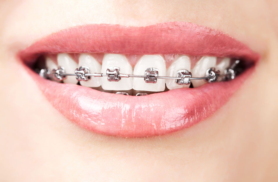  Benefits of metal braces