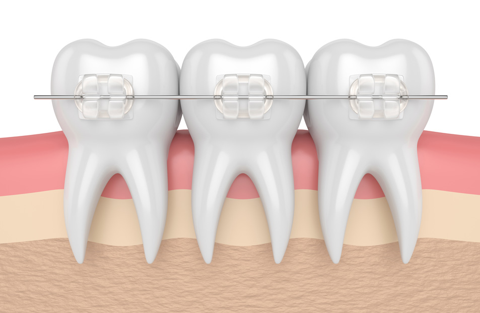 See how ceramic braces could straighten your smile