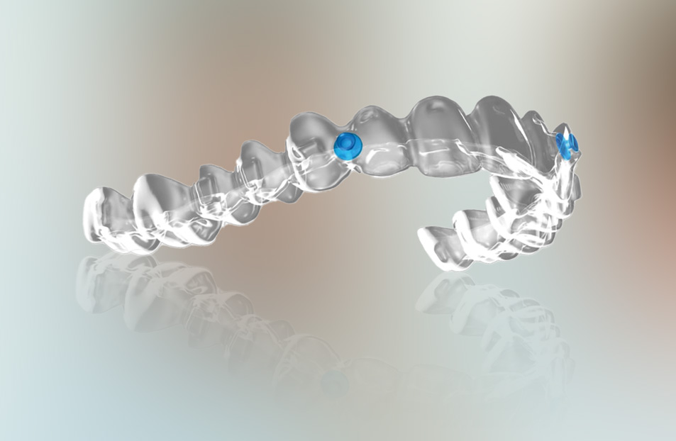 What are Angel Aligners?