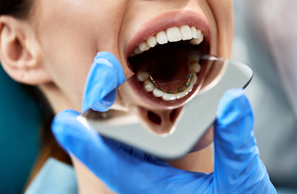  What's the cost of lingual braces in London?